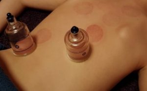 Therapieverfahren 5 Schröpfbehandlungen