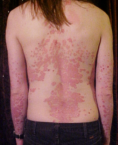 Fallstudie zum Thema "Psoriasis vulgaris plaque" 1 Fallstudie zum Thema "Psoriasis vulgaris plaque" 1